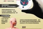h7n9診療方案 衛(wèi)計(jì)委公