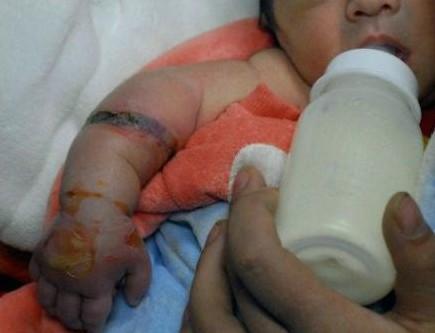 小寶寶衣服寬松 奶奶在他袖子上纏繩子造成小寶寶手臂壞死