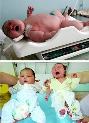 湖北200斤產婦產巨嬰