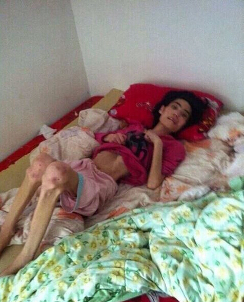 女子遭婆婆虐待體重只有40斤