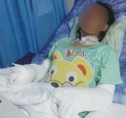 手持氫氣球爆炸燒成造成20%燒傷,溫州女子被氫氣球炸傷