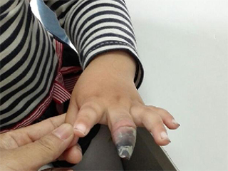 4歲女童創(chuàng)可貼使用不當(dāng)截肢