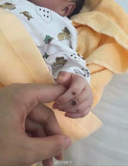 兔唇男嬰被棄荒野