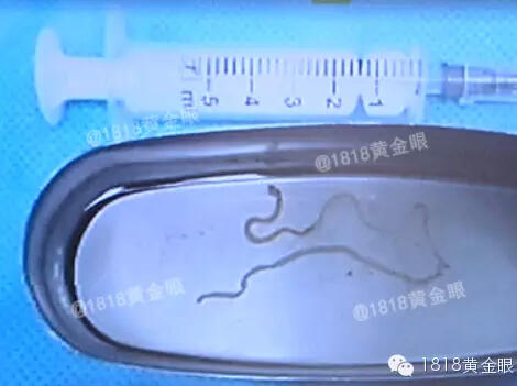 曼氏裂頭蚴寄生蟲鉆入大腦:嘉興12歲女孩腦中取出20厘米寄生蟲