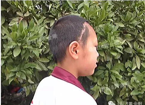 曼氏裂頭蚴寄生蟲鉆入大腦:嘉興12歲女孩腦中取出20厘米寄生蟲