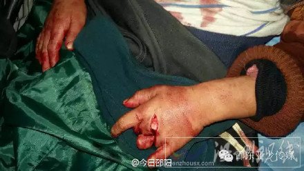 湖南6歲男童生殖器被割掉