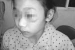 四川江油市11歲女孩被養(yǎng)父母虐待 被打得渾身是傷