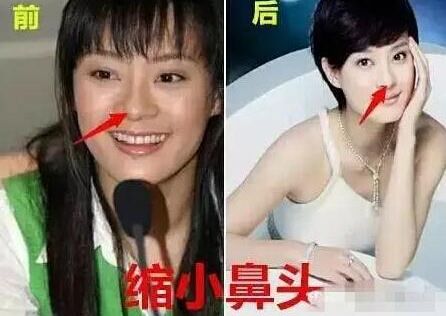 孫儷自曝整過容