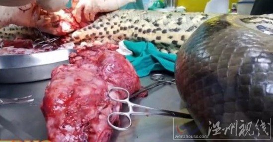 醫生為巨蟒切腫瘤